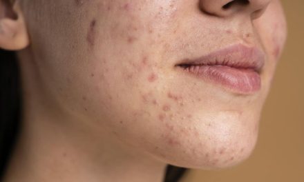 Atasi Jerawat Pada Kulit Sensitif Tanpa Takut Iritasi