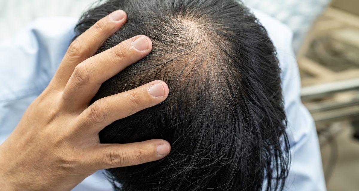 Cara Mengatasi Rambut Rontok Dengan Perawatan Yang Tepat