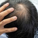 Cara Mengatasi Rambut Rontok Dengan Perawatan Yang Tepat