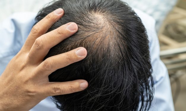 Cara Mengatasi Rambut Rontok Dengan Perawatan Yang Tepat